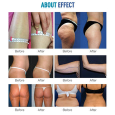 40k+80k Cavitation Slimming System results